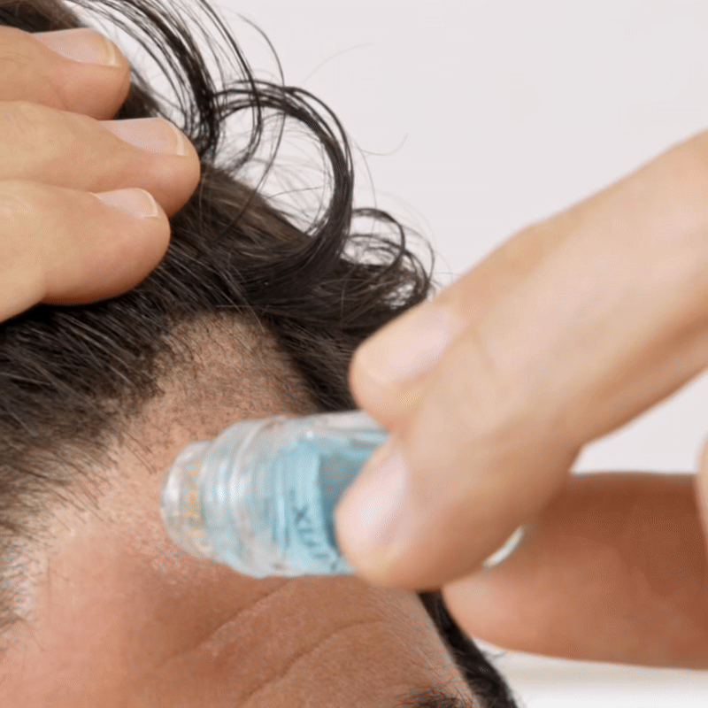 6. Studies Show Microneedling is 3x More Effective Than Minoxidil Alone