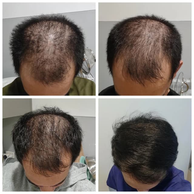 1. 37,454 Men Have Ditched Their Caps Thanks to OneFix